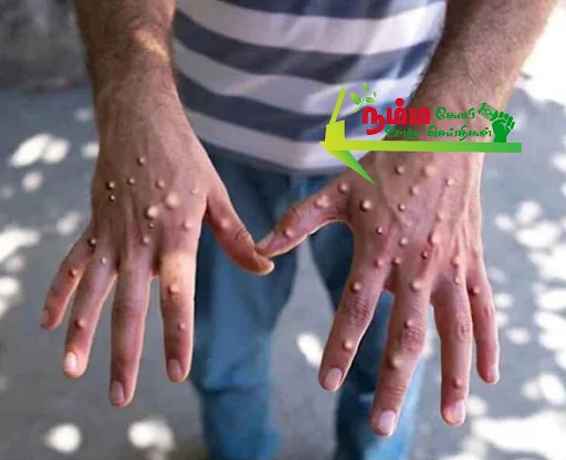 mpox: Medical Department Alert